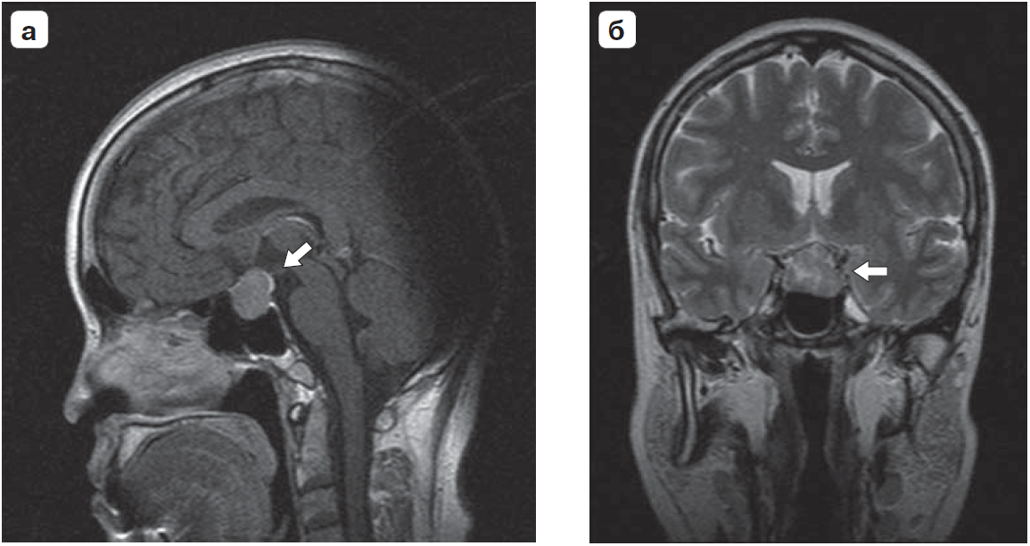 Опухоль гипофиза