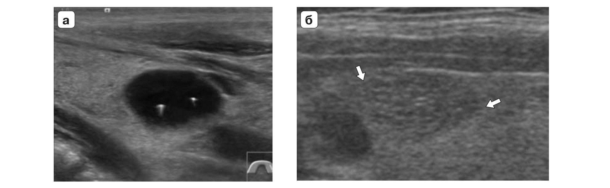 Гипоэхогенное округлое образование